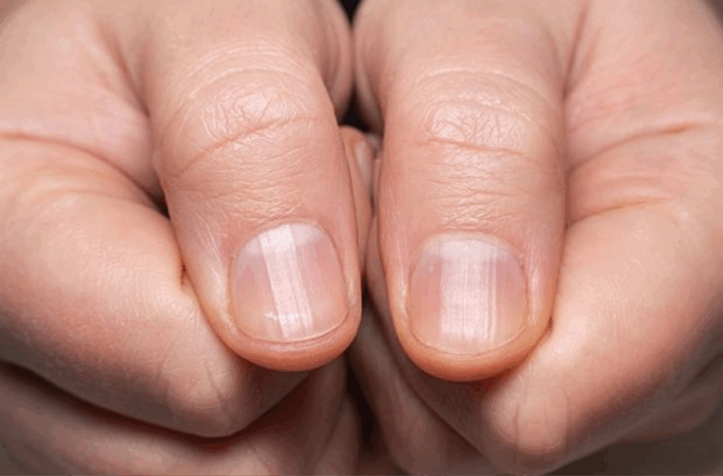 Bei-Vertikalen-und-Horizontalen-Nagelrillen