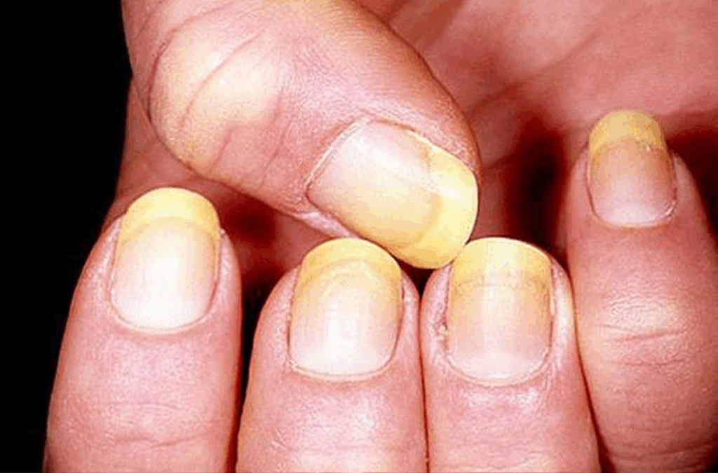 Gelbe-Fingernägel