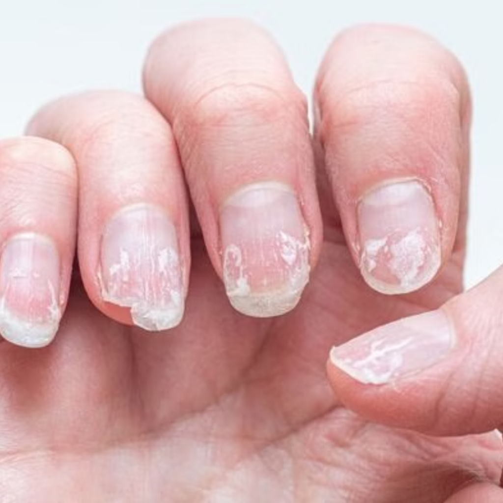 Zu viel Feuchtigkeit führt dazu, dass sich die Nägel ständig ausdehnen und wieder zusammenziehen. Dadurch wird die Nagelstruktur mit der Zeit geschwächt und es entstehen brüchige Fingernägel.