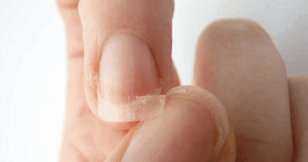 Anzeichen und Ursachen von splitternde fingernägel