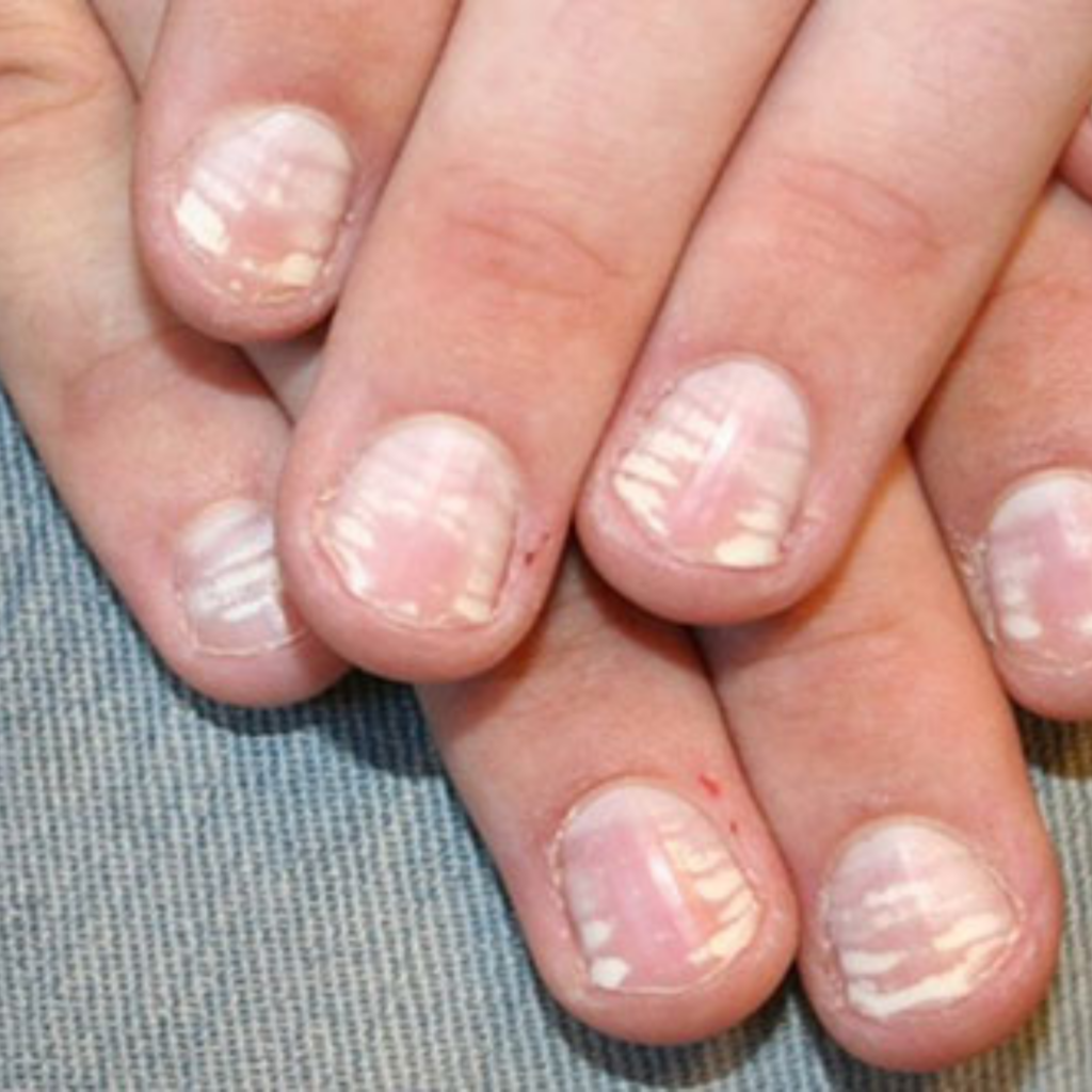 Anämie verringert die Versorgung der Nägel mit Sauerstoff und Nährstoffen, wodurch sie schwächer werden und leichter brechen – es entstehen brüchige Fingernägel.