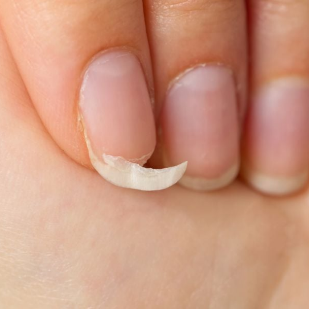 brüchige fingernägel