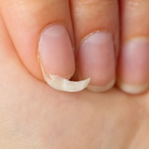 brüchige fingernägel