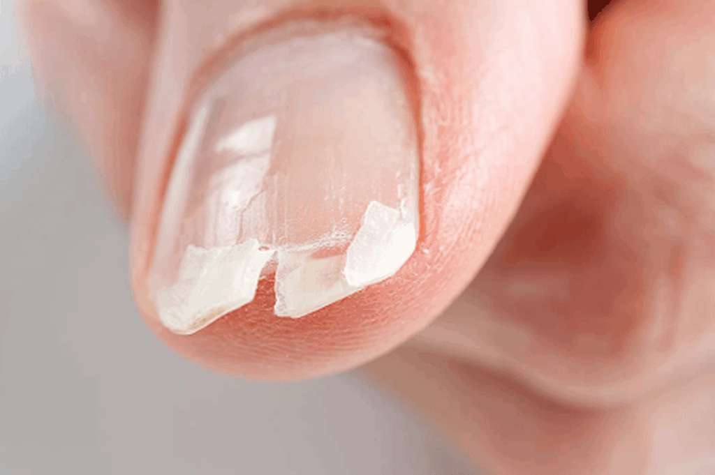 splitternde fingernägel am Nagelende sichtbar