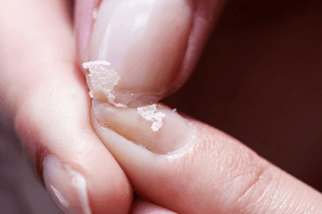 beschädigte Nageloberfläche bei Nagelablösung