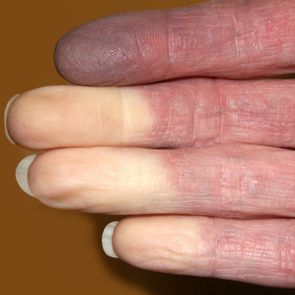Das Raynaud-Syndrom verringert die Durchblutung der Hände, wodurch die Nägel nicht ausreichend mit Nährstoffen versorgt werden und schwach, spröde und brüchige Fingernägel entstehen können.